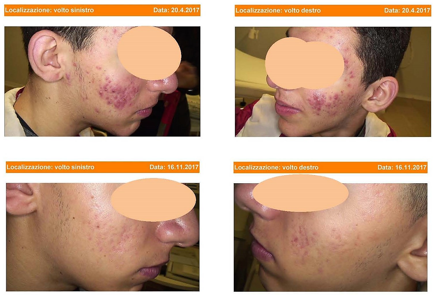trattamento acne nosulo cistica prima e dopo sei mesi di terapia