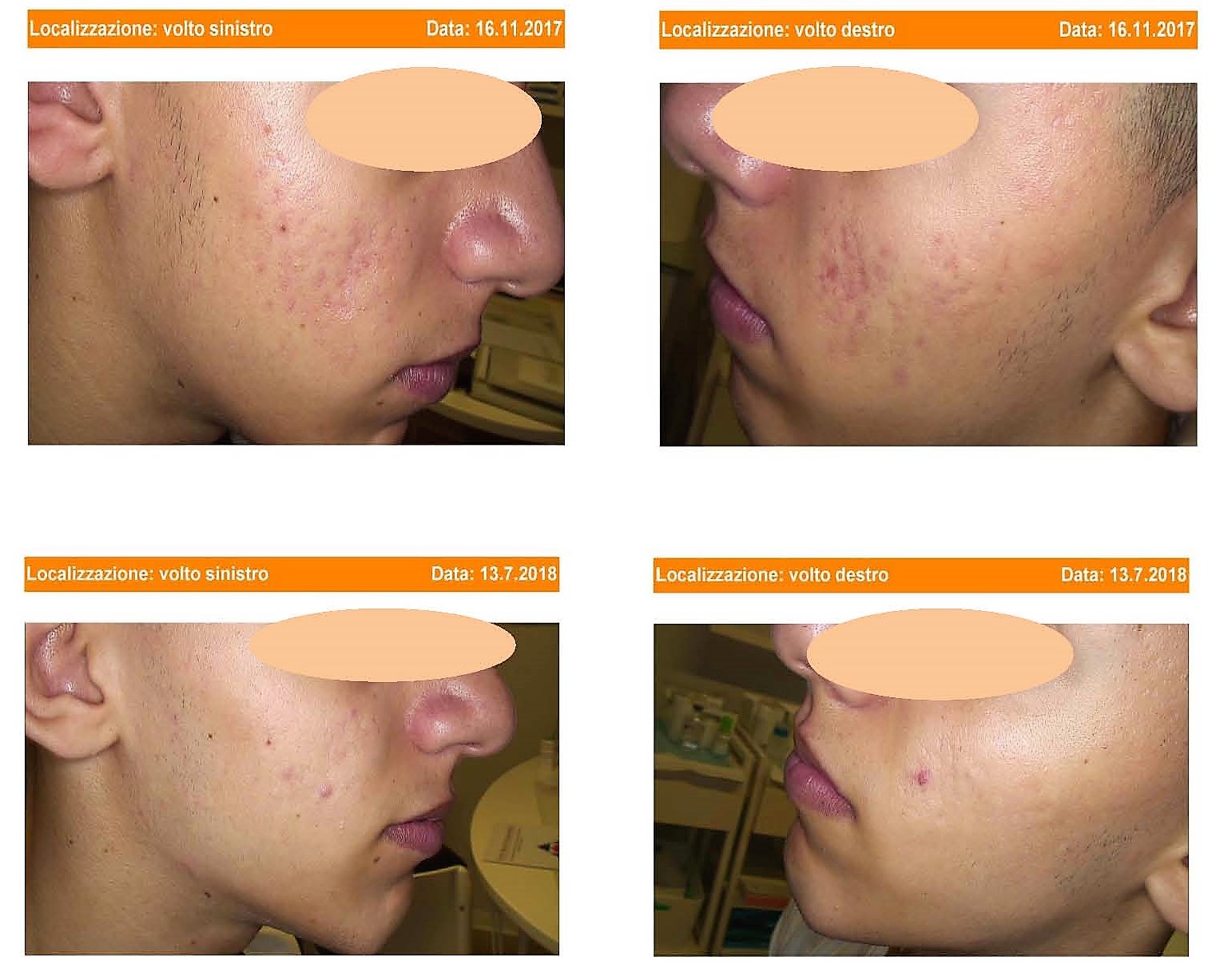Trattamento cicatrici post acne nodulo cicstica